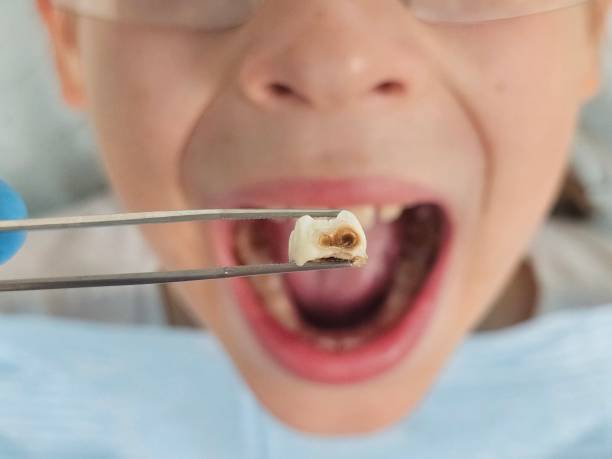 Best Emergency Tooth Extraction in Sayreville, NJ